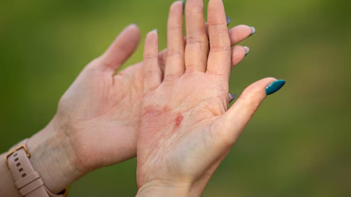 Do You Have Atopic Dermatitis? Here’s How It Can Put You At Risk Of Food Allergies