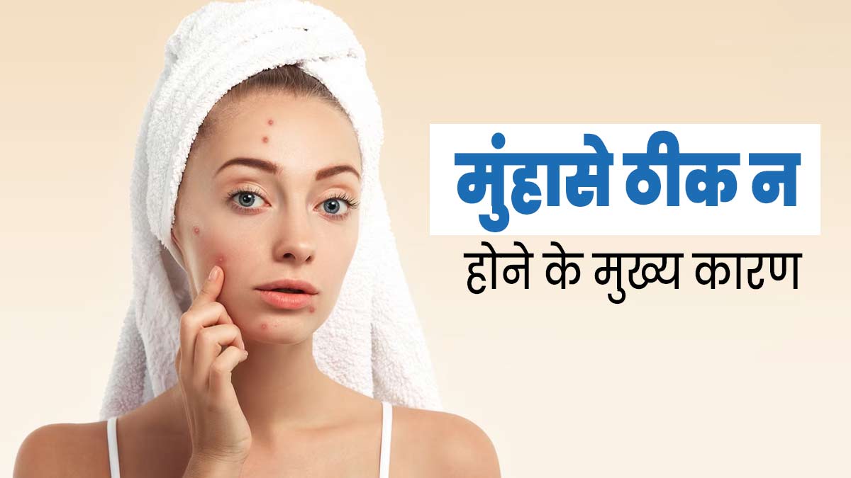 मुंहासे ठीक न होने के पीछे ये 4 कारण हो सकते हैं जिम्मेदार, जानें इनके बारे में
