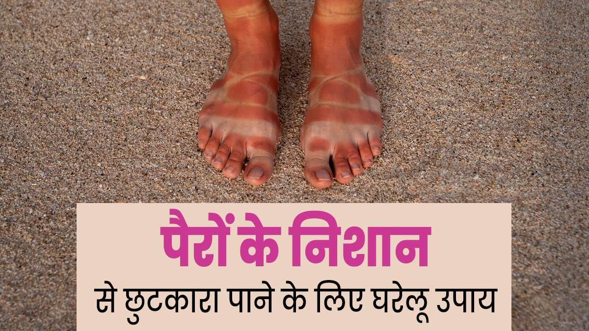 धूप से पैरों पर पड़ गए हैं जूते-चप्पल के निशान, जानें इससे छुटकारा पाने के 5 घरेलू उपाय 