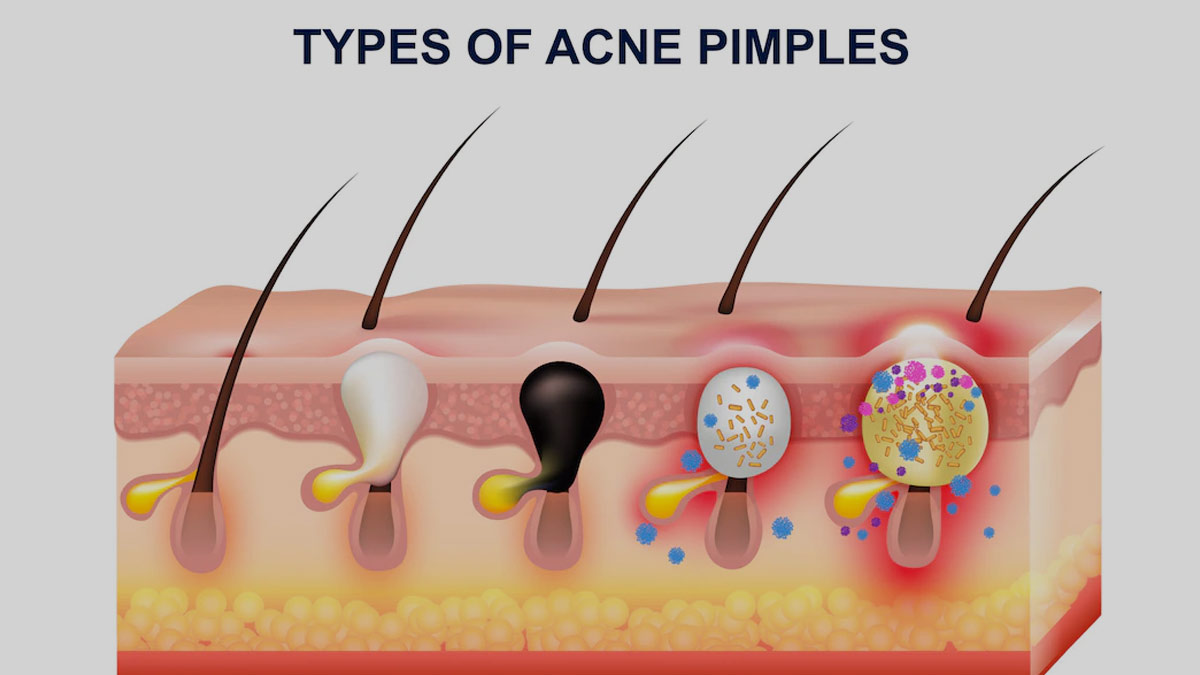 Suffering From Acne This Summer? Here Are 6 Ways You Can Get Rid of It