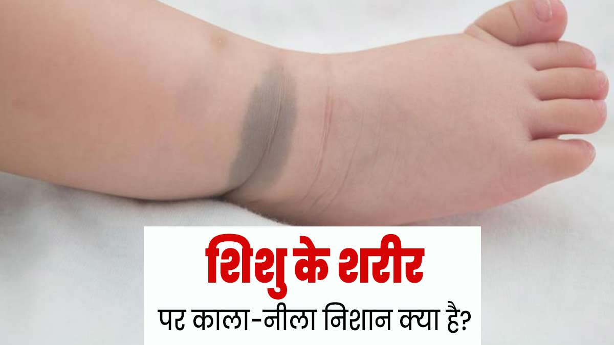 शिशु के शरीर पर काले-नीले निशान हैं मंगोल‍ियन स्‍पॉट के लक्षण, डॉक्‍टर से जानें क्‍या है यह  