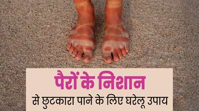 धूप से पैरों पर पड़ गए हैं जूते-चप्पल के निशान, जानें इससे छुटकारा पाने के 5 घरेलू उपाय 