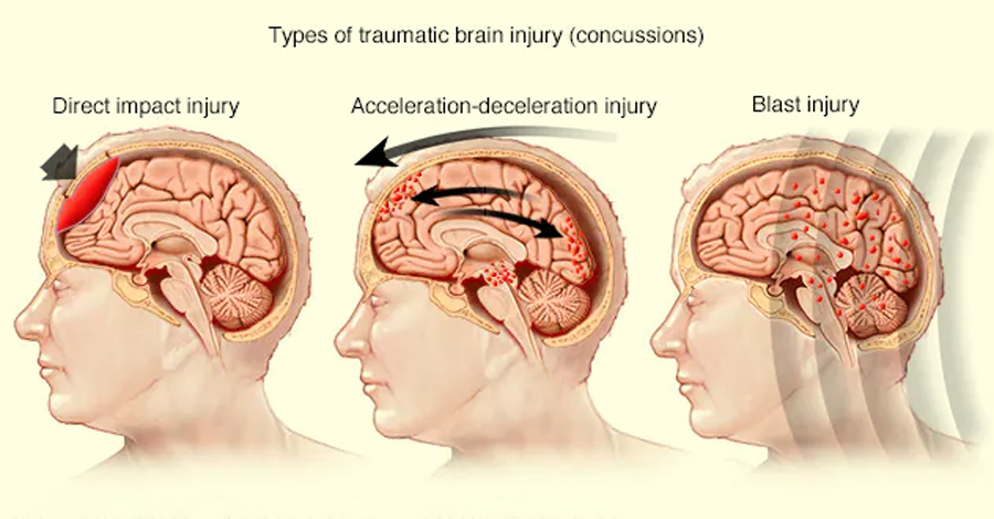 Concussion