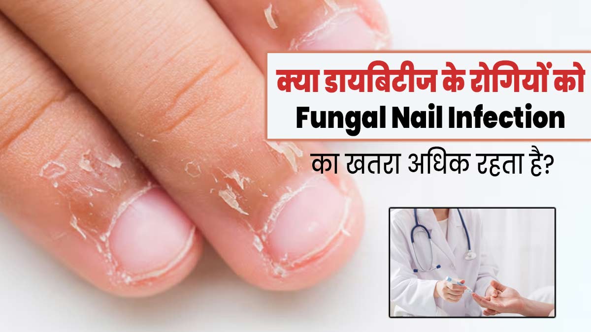 डायबिटीज रोगियों में क्यों रहता है फंगल नेल इंफेक्शन होने का अधिक जोखिम? एक्सपर्ट से जानें कारण