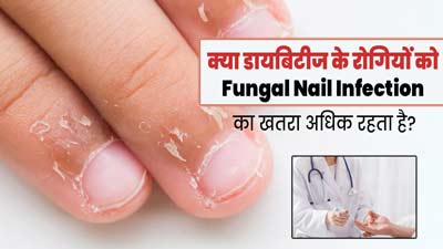 डायबिटीज रोगियों में क्यों रहता है फंगल नेल इंफेक्शन होने का अधिक जोखिम? एक्सपर्ट से जानें कारण