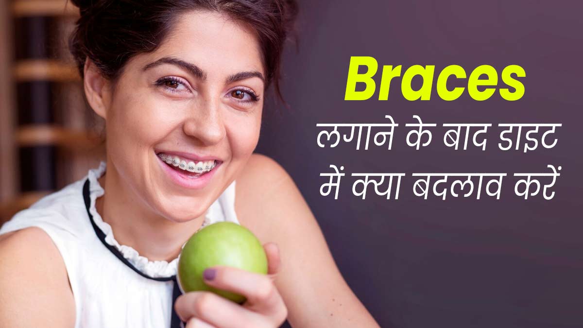 दांतों में ब्रेसेस लगवाने के बाद क्या खाएं और क्या नहीं? एक्सपर्ट से जानें
