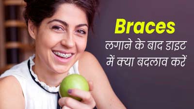 दांतों में ब्रेसेस लगवाने के बाद क्या खाएं और क्या नहीं? एक्सपर्ट से जानें