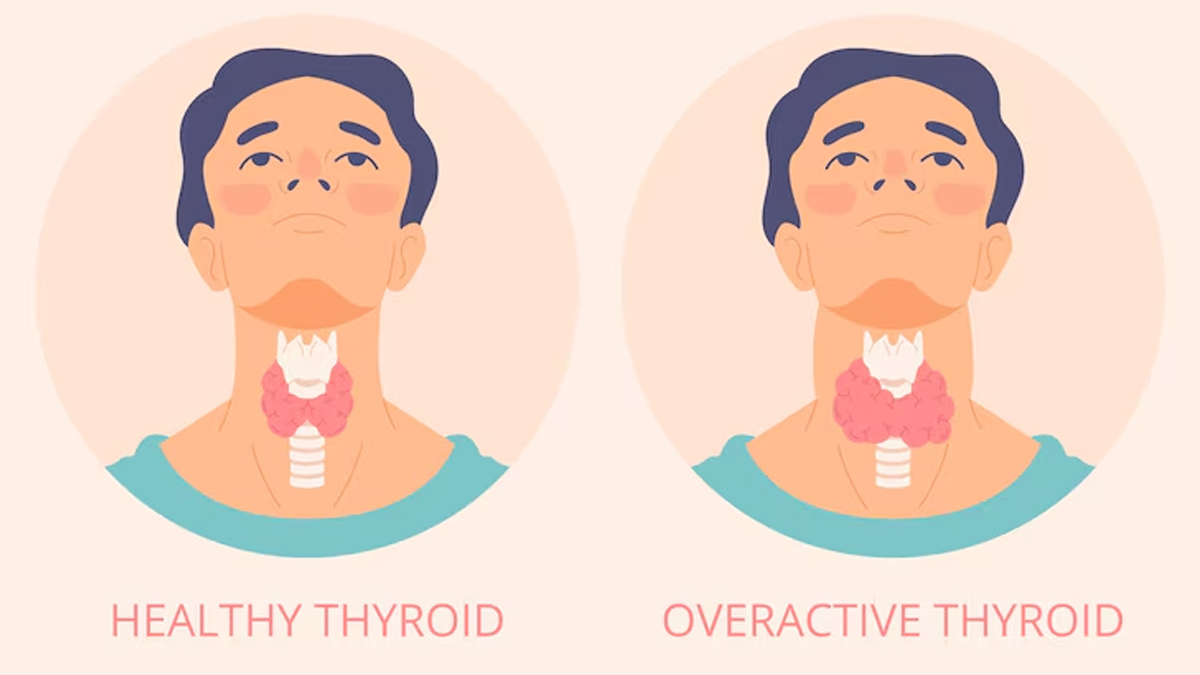 World Thyroid Day 2024: Theme, History And Significance, All That You ...