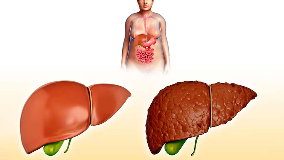 Fatty Liver Disease and Cancer