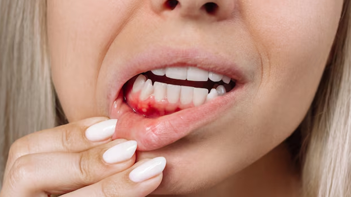 gum-disease