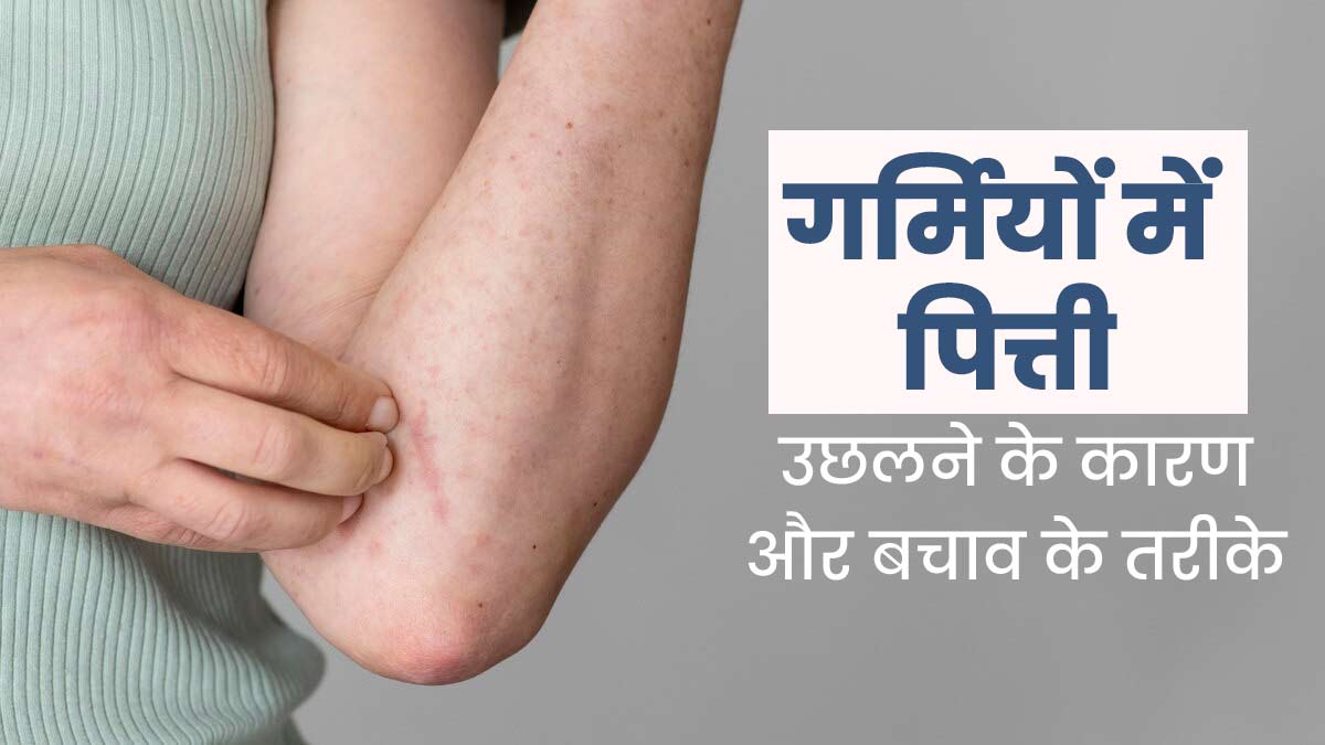 गर्मियों में पित्ती उछलने के कारण और बचाव के तरीके, आयुर्वेदाचार्य से जानें