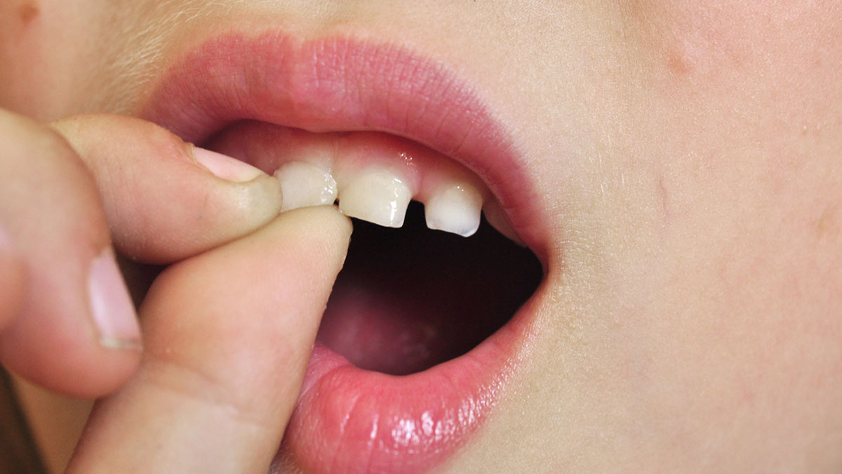 Dealing With Loose Tooth? Here Are Its Causes And Ways To Strengthen It ...