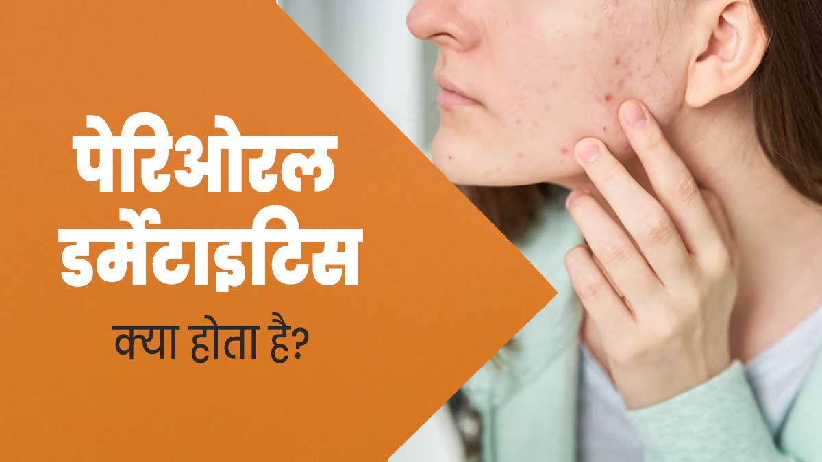 पेरिओरल डर्मेटाइटिस क्या होता है? जानें एक्सपर्ट से इस बारे में