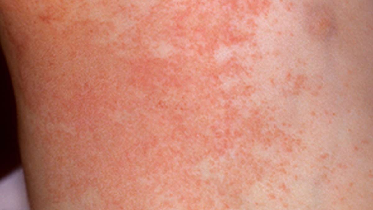 heat rash
