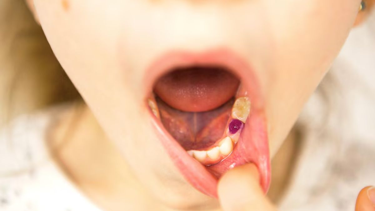 Risk Factors of Mouth Cancer