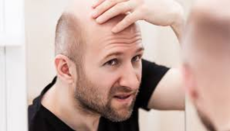 Genetic Hair Loss