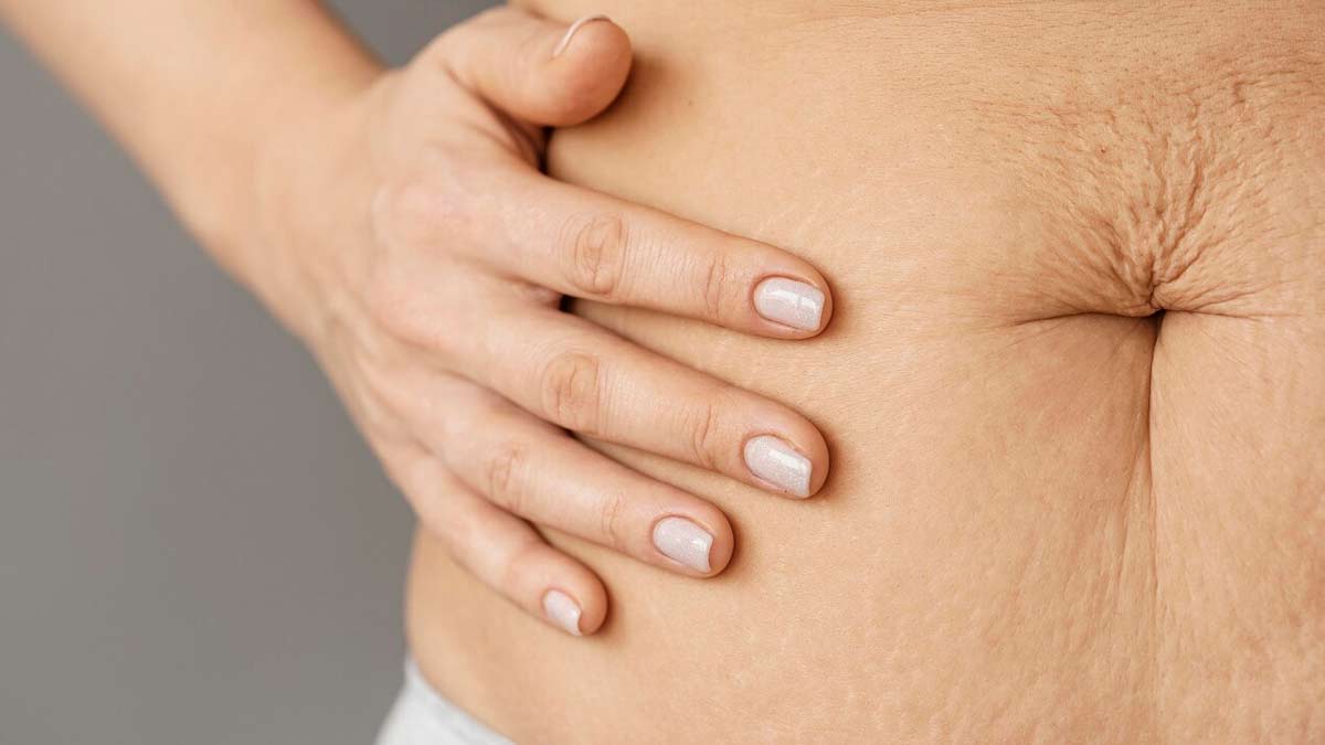 can stretch marks cure completely 