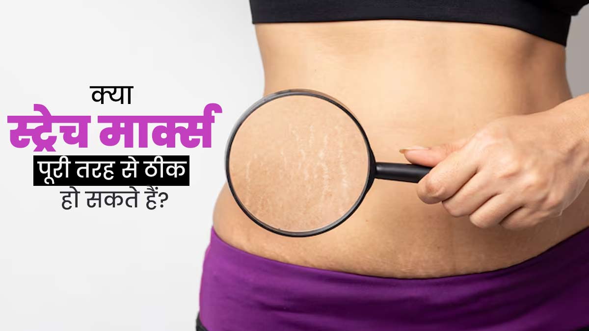 क्या स्ट्रेच मार्क्स पूरी तरह से ठीक हो सकते हैं? डॉक्टर से जानें 