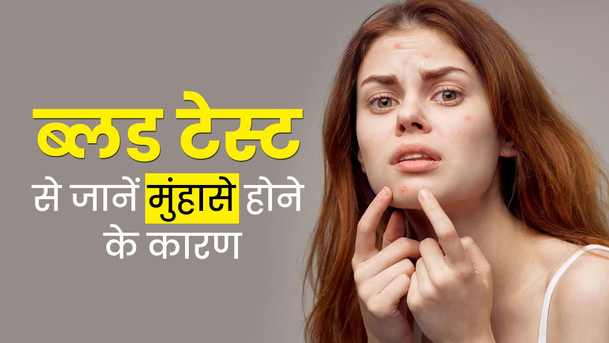 क्या आपको भी हो रही है मुंहासों की समस्या? ब्लड टेस्ट से जानें इसके कारण 
