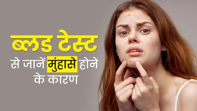 क्या आपको भी हो रही है मुंहासों की समस्या? ब्लड टेस्ट से जानें इसके कारण 
