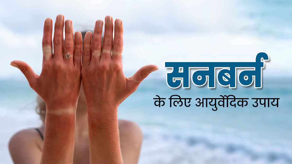 गर्मियों में सनबर्न से छुटकारा पाने के लिए आजमाएं ये 4 आयुर्वेदिक उपाय, मिलेगा फायदा