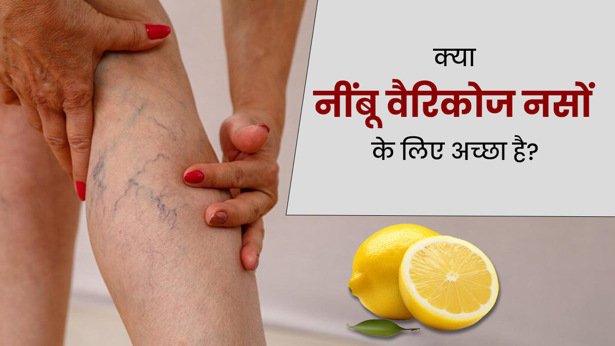 क्या नींबू वैरिकोज वेन्स (उभरी नीली नसों) के लिए अच्छा होता है? एक्सपर्ट से जानें