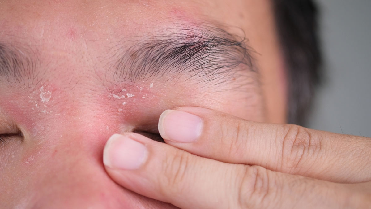 Flaky Eyebrows: Here Are 8 Natural Ways To Get Rid Of Brow Dandruff