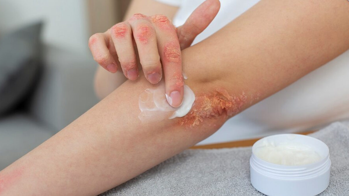 These Tips Can Help You Practice Safe Hair Removal If You Have Severe Eczema