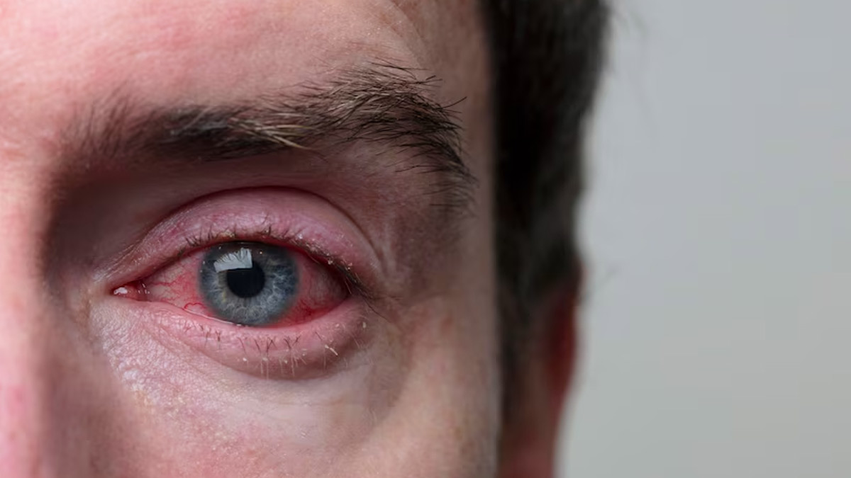 Pink Eye: Ayurvedic Doctor Shares Tips To Manage Conjunctivitis