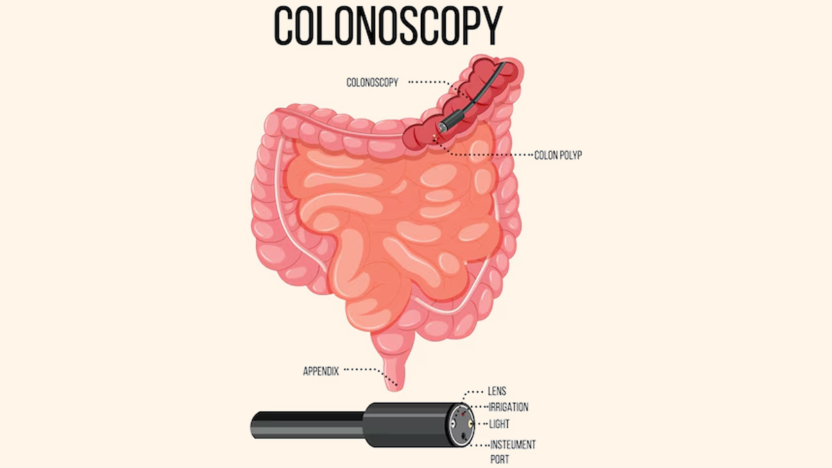 colonoscopy