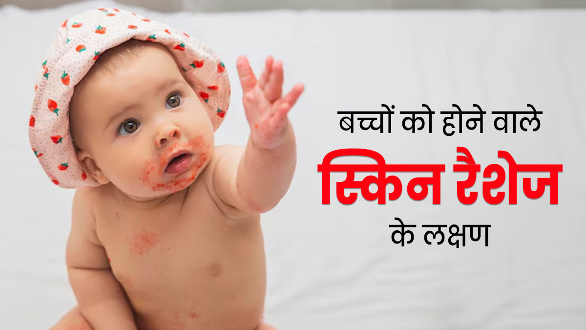बच्चों में आम होते हैं ये 5 तरह के स्किन रैशेज, डॉक्टर से जानें इनके लक्षण और बचाव के उपाय