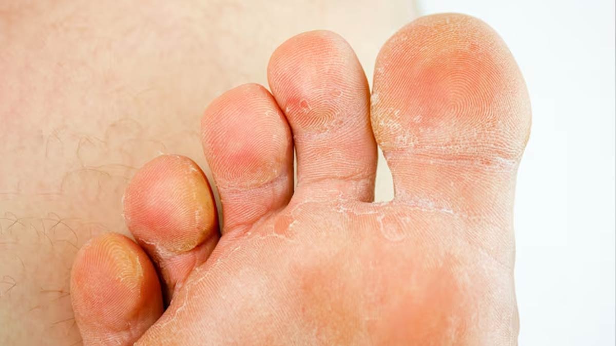 KOH test for fungal infection