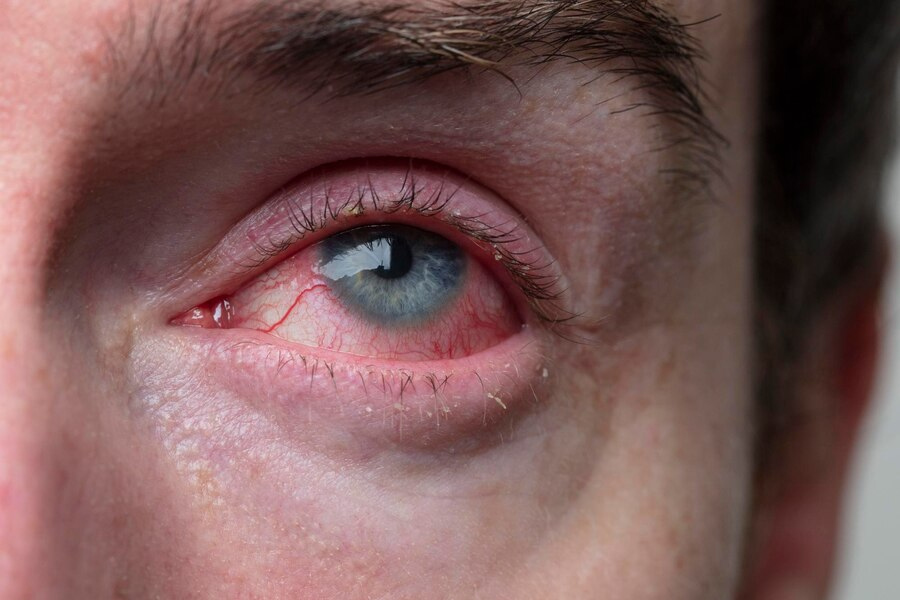 Conjunctivitis 