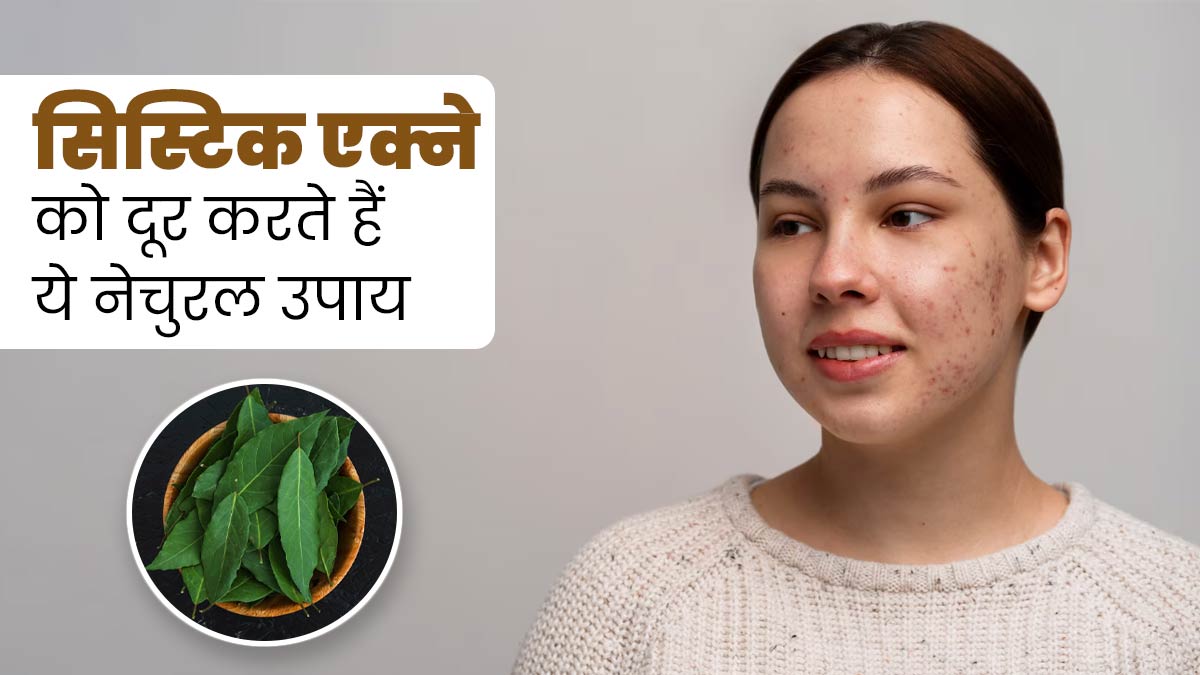Cystic Acne: मवाद से भरे हुए मुंहासों से छुटकारा दिलाएंगे ये 5 नेचुरल उपाय, करें ट्राई