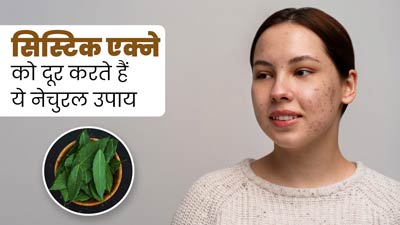 Cystic Acne: मवाद से भरे हुए मुंहासों से छुटकारा दिलाएंगे ये 5 नेचुरल उपाय, करें ट्राई