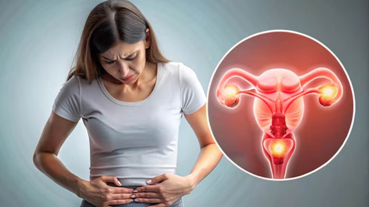 PCOS