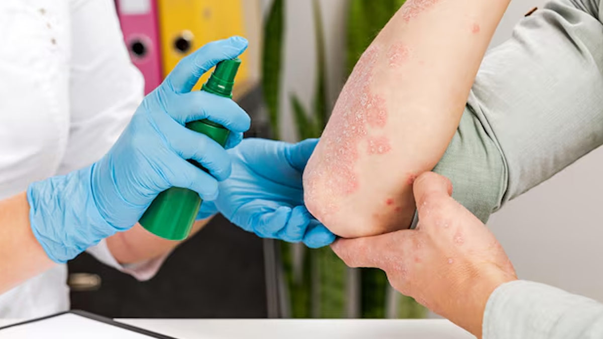 Some Fungal Infections Can Be Contagious: Doctor Shares Prevention Tips