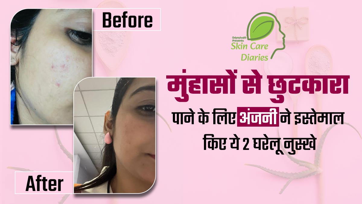 मुंहासों और दाग-धब्बों से परेशान थीं अंजनी खत्री, समस्या से छुटकारा पाने के लिए इस्तेमाल किए ये 2 घरेलू नुस्खे