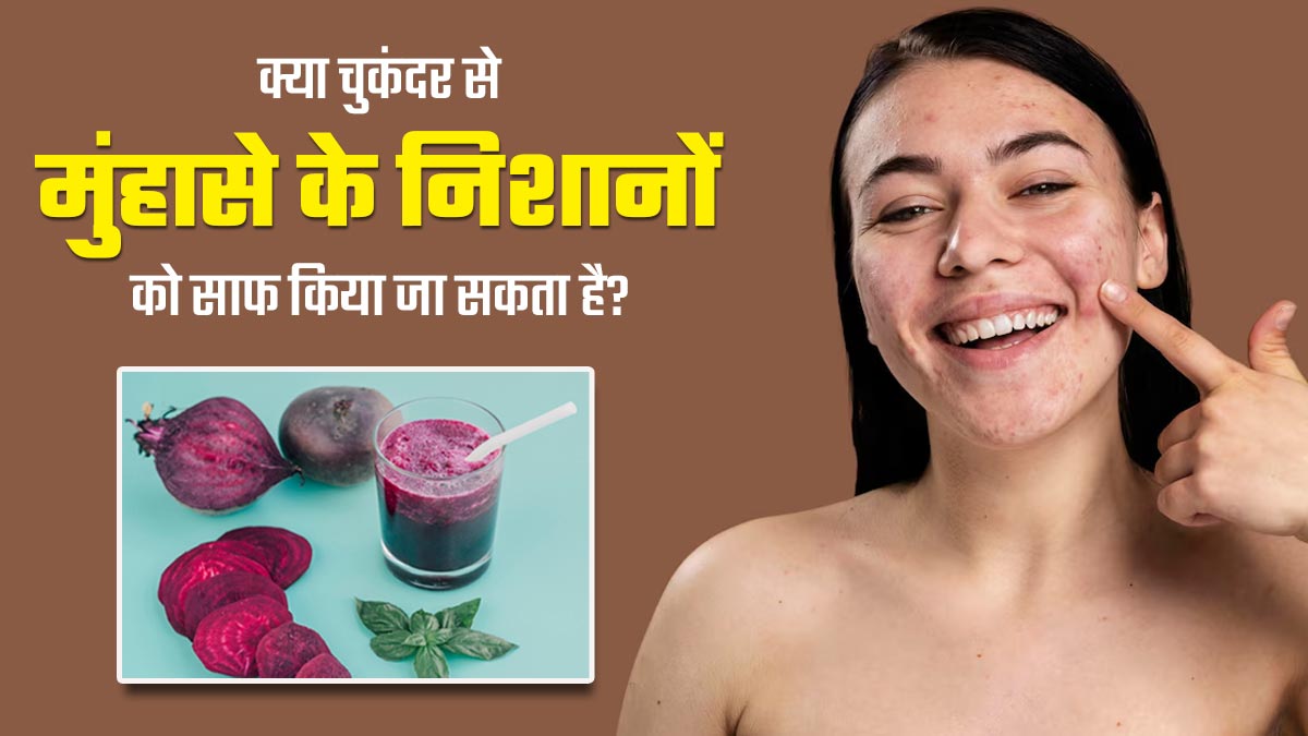 मुंहासों के निशान मिटाने के लिए इन 3 तरीकों से इस्तेमाल करें चुकंदर, मिलेगा फायदा