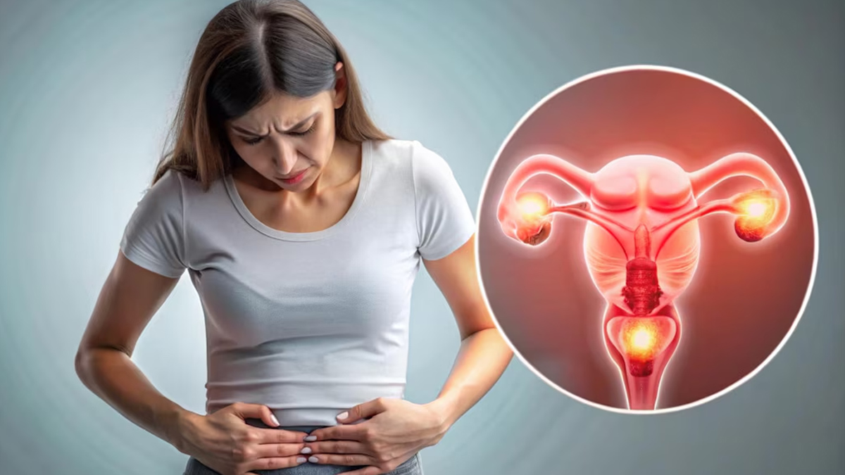 PCOS