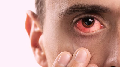 Home Remedies For Eye Allergies: Doctor Shares Tips For Eye Care