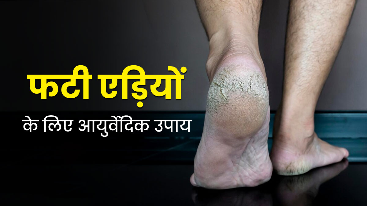 फटी एड़ियों से छुटकारा पाने के लिए अपनाएं ये 4 आयुर्वेदिक उपाय, बढ़ जाएगी पैरों की खूबसूरती