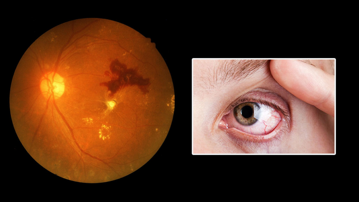 डायबिटीज से होने वाली आंखों की बीमारी (Diabetic Retinopathy) का इलाज कैसे होता है? जानें इसके ट्रीटमेंट ऑप्शन