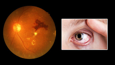 डायबिटीज से होने वाली आंखों की बीमारी (Diabetic Retinopathy) का इलाज कैसे होता है? जानें इसके ट्रीटमेंट ऑप्शन