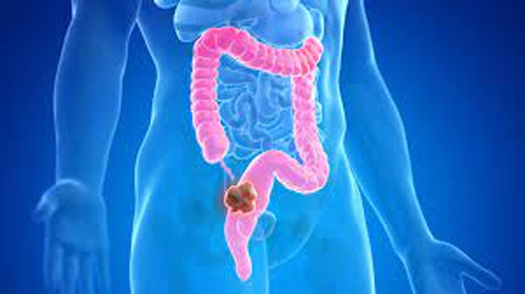 Colorectal Cancer