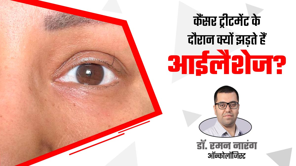 झड़ गईं हिना खान की सारी पलकें, डॉक्टर से जानें कैंसर के इलाज के दौरान ऐसा क्यों होता है?