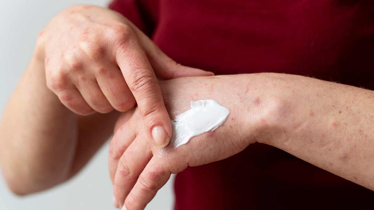 how to manage chronic inflammation with psoriasis