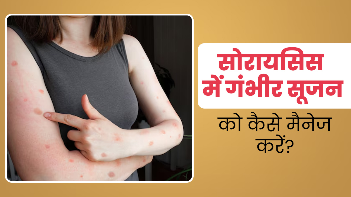 सोरायसिस के कारण हो गई है सूजन, तो राहत पाने के लिए अपनाएं ये 5 उपाय