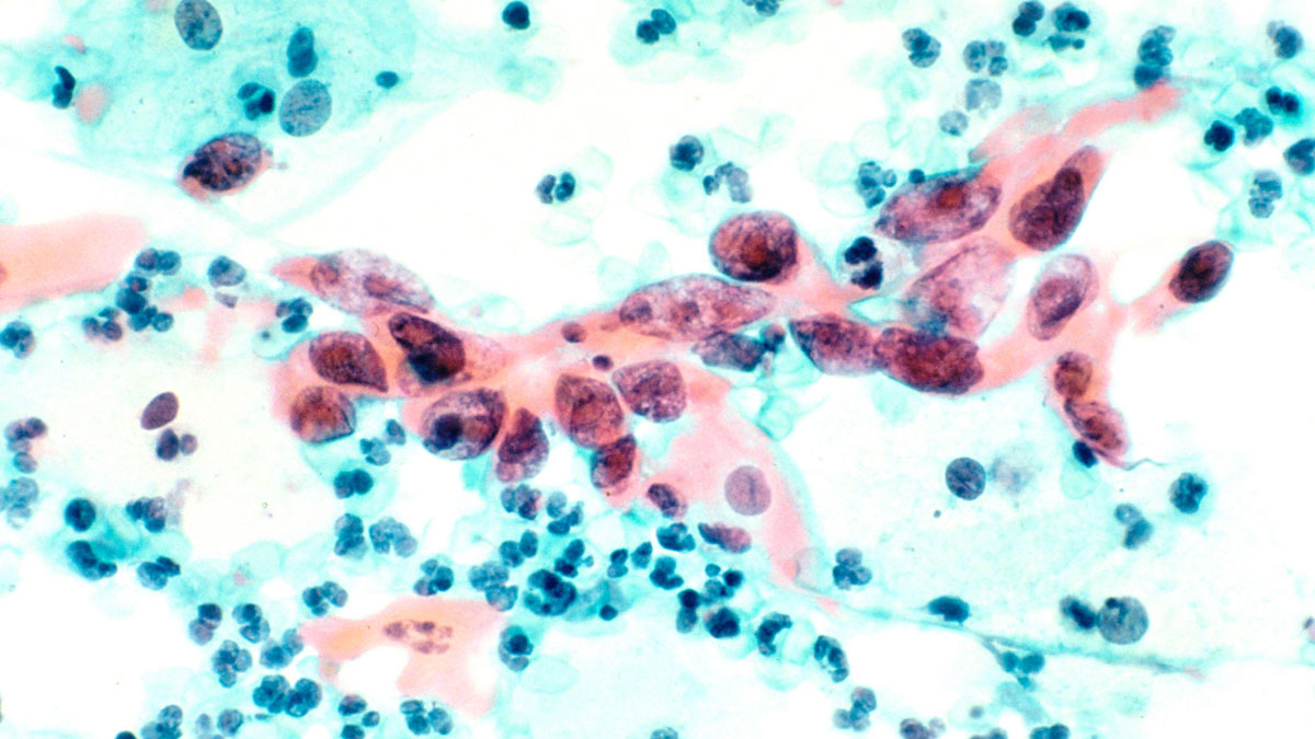 Cervical Cancer