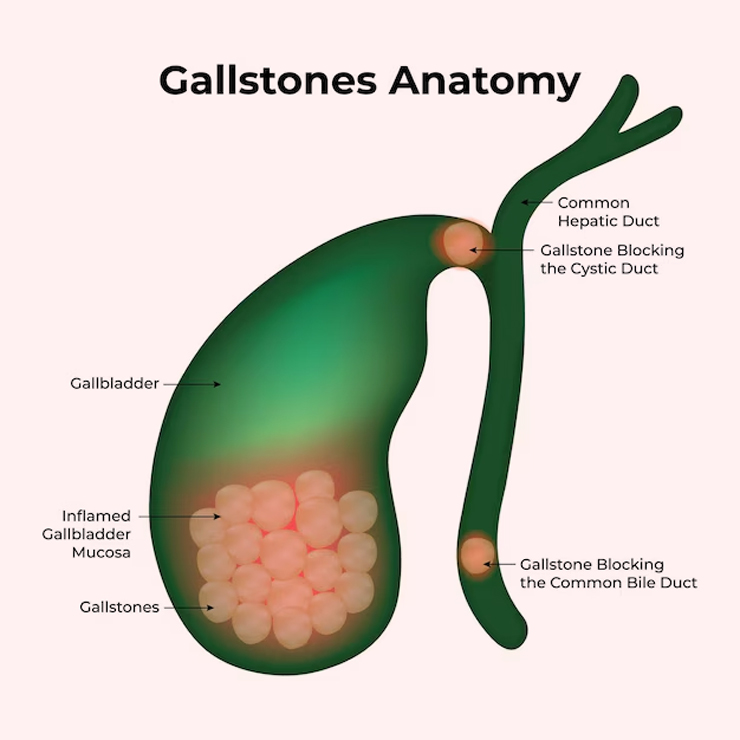 Gallbladder stones